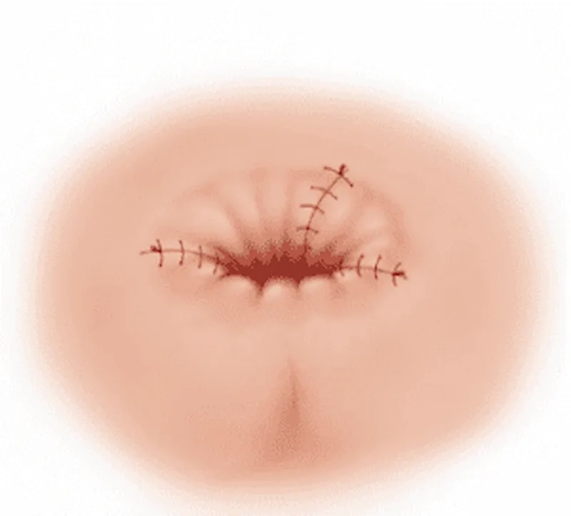 Técnica de Ferguson (hemorroidectomia fechada)