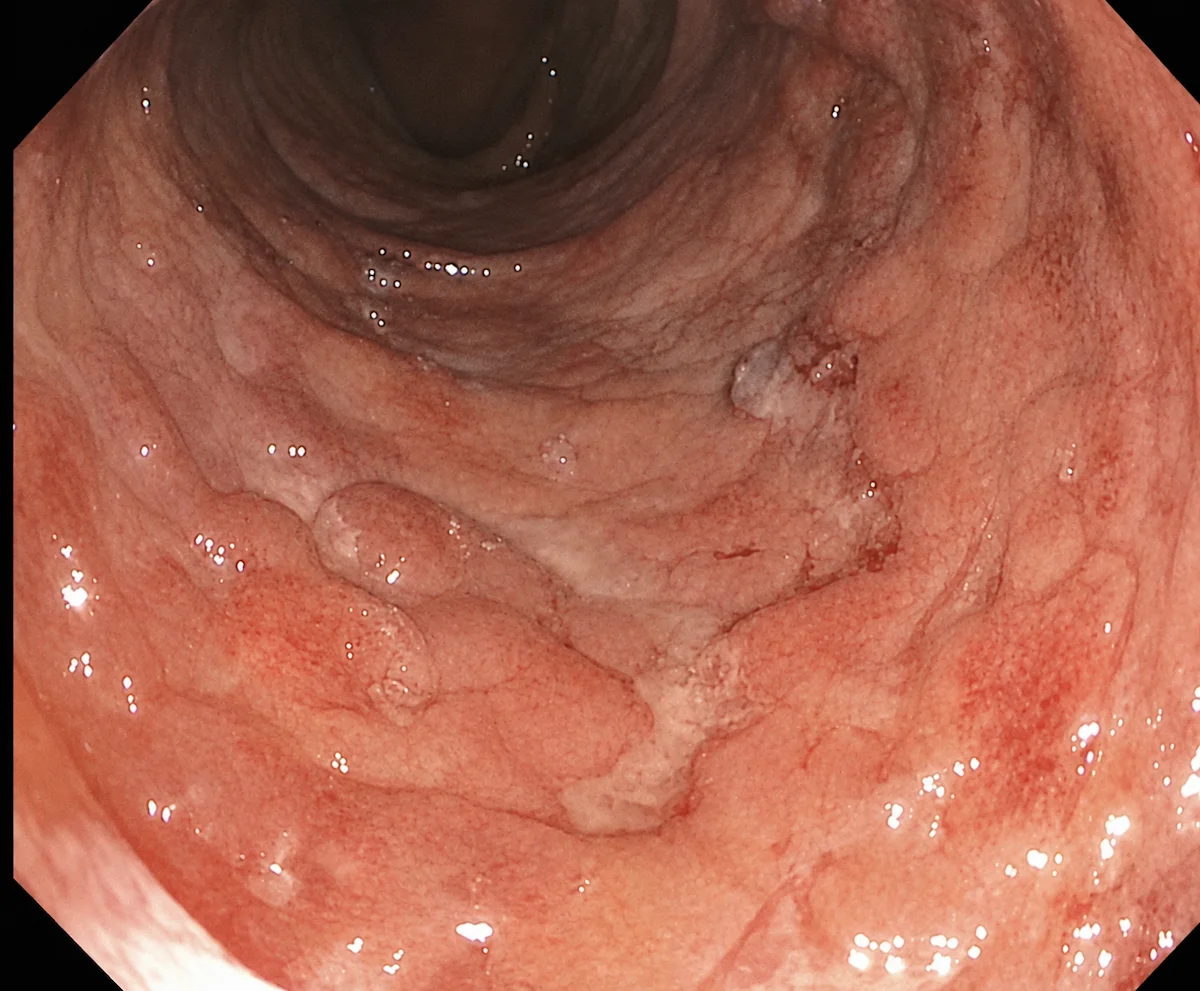 Colonoscopia mostrando mucosa intestinal inflamada, com úlceras e aspecto irregular associado à doença de Crohn.