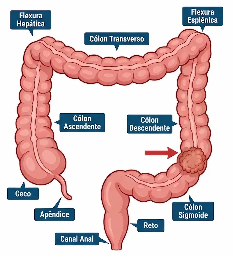 Ilustração anatômica do intestino grosso com suas principais regiões identificadas e uma lesão tumoral no cólon descendente