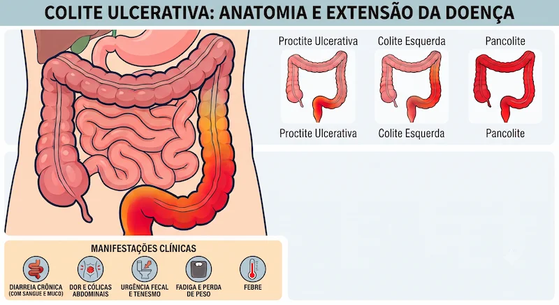 Ilustração do intestino grosso — retocolite ulcerativa