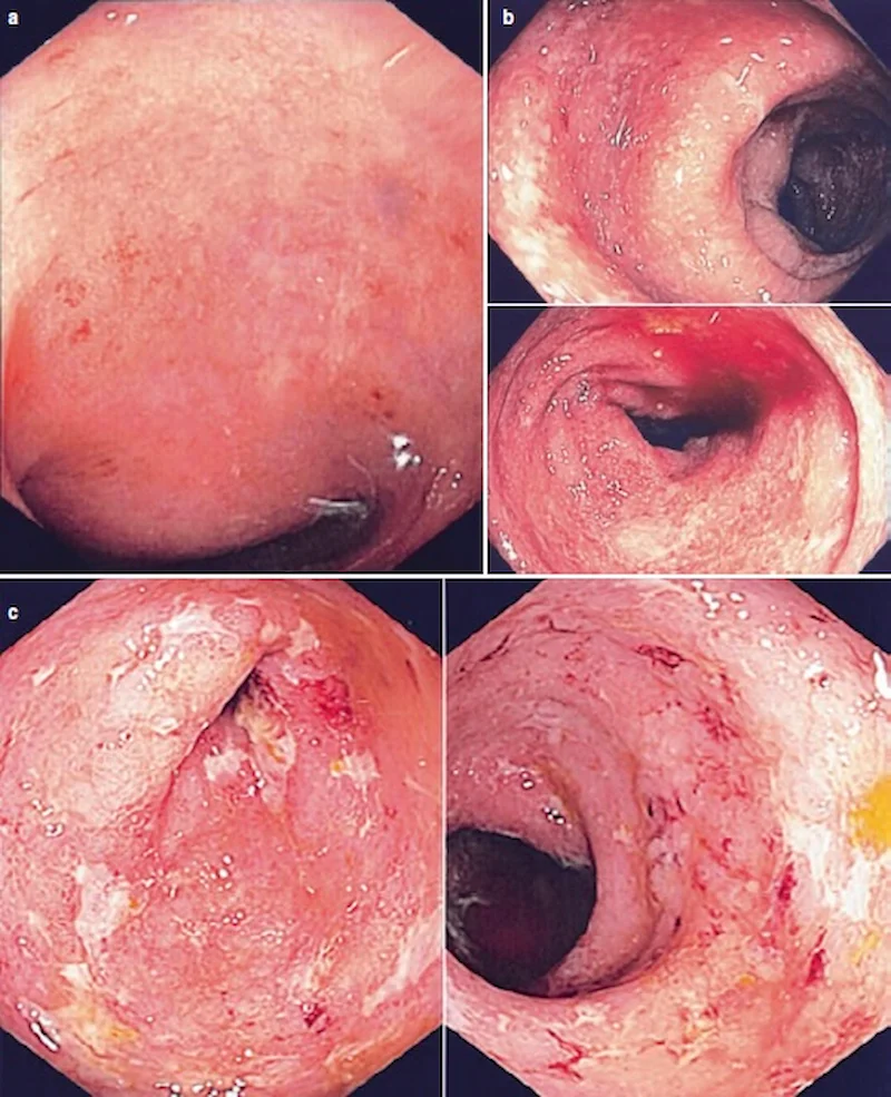 Colonoscopia — exame fundamental no diagnóstico da retocolite ulcerativa