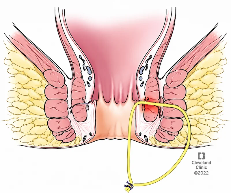 Ilustração médica em corte frontal da região anal e do reto inferior, com tecidos em tons de rosa e amarelo