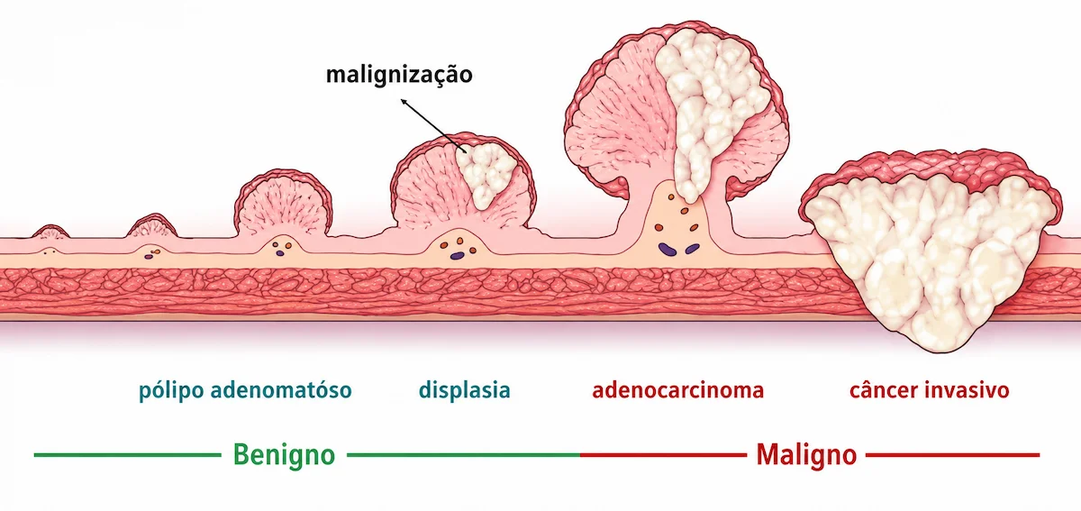 Progressão de pólipo adenomatoso benigno para displasia, adenocarcinoma e câncer colorretal invasivo.